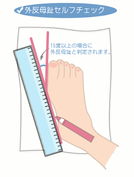 外反母趾かどうかは２０度以上が目安です きこうカイロ施術院