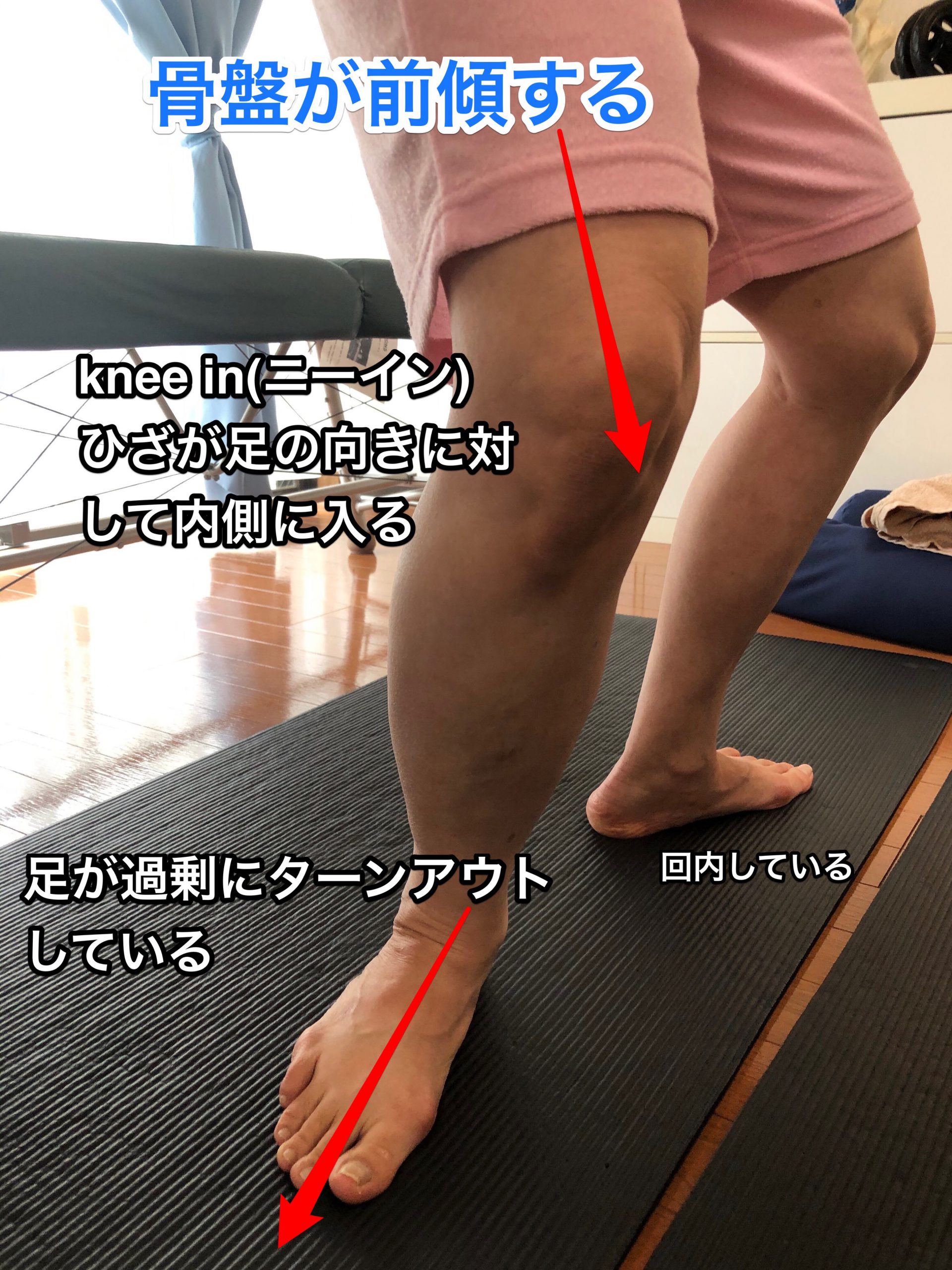 骨盤前傾 偽ヒップアップ 反り腰 の癖があるとまずい理由 ひざ痛にも関わるふくらはぎと足裏の筋肉が弱る きこうカイロ施術院