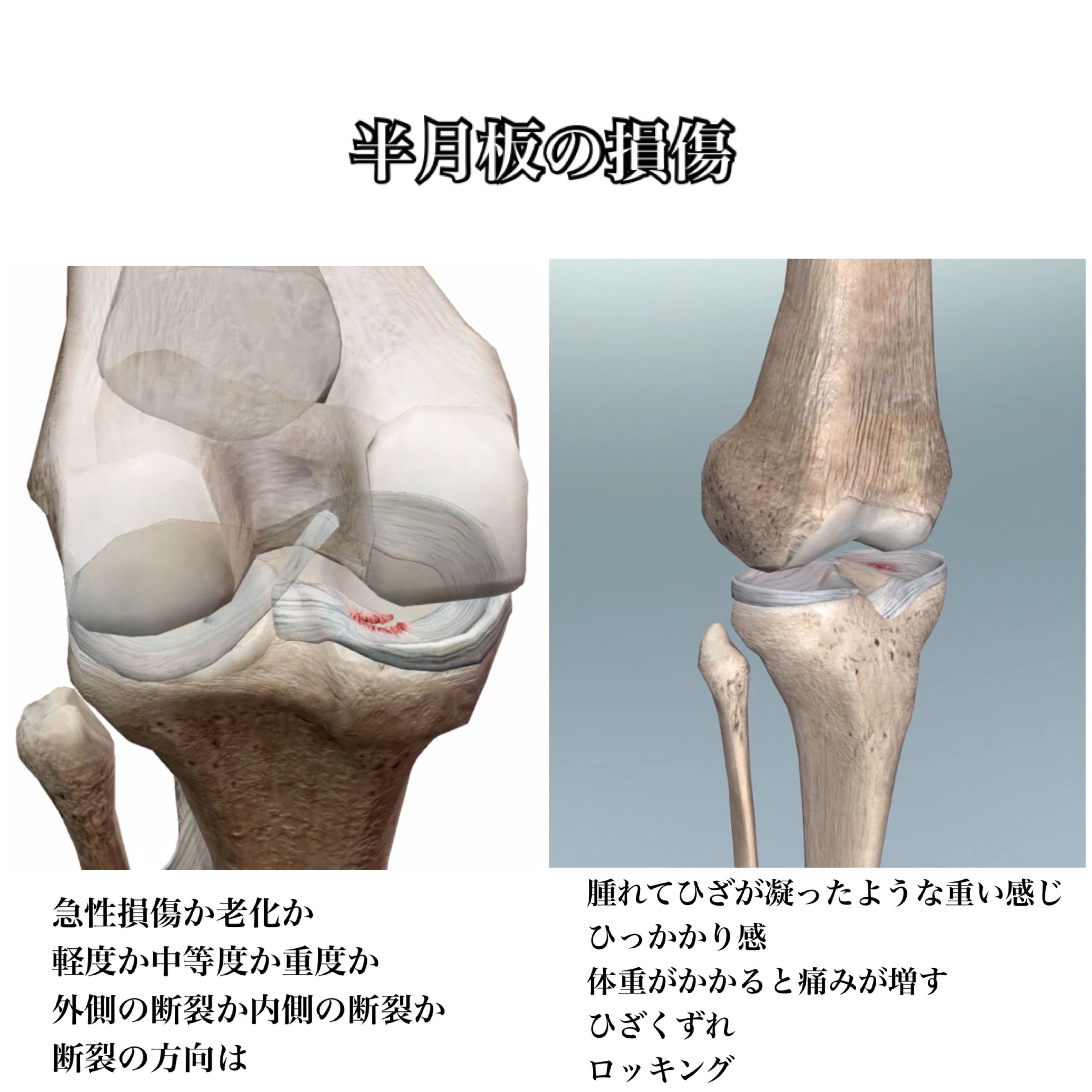 ひざ痛克服 ひざの前側の痛み をとるためにはまずひざの中身を知る 鍛えるべき筋肉を理解する きこうカイロ施術院